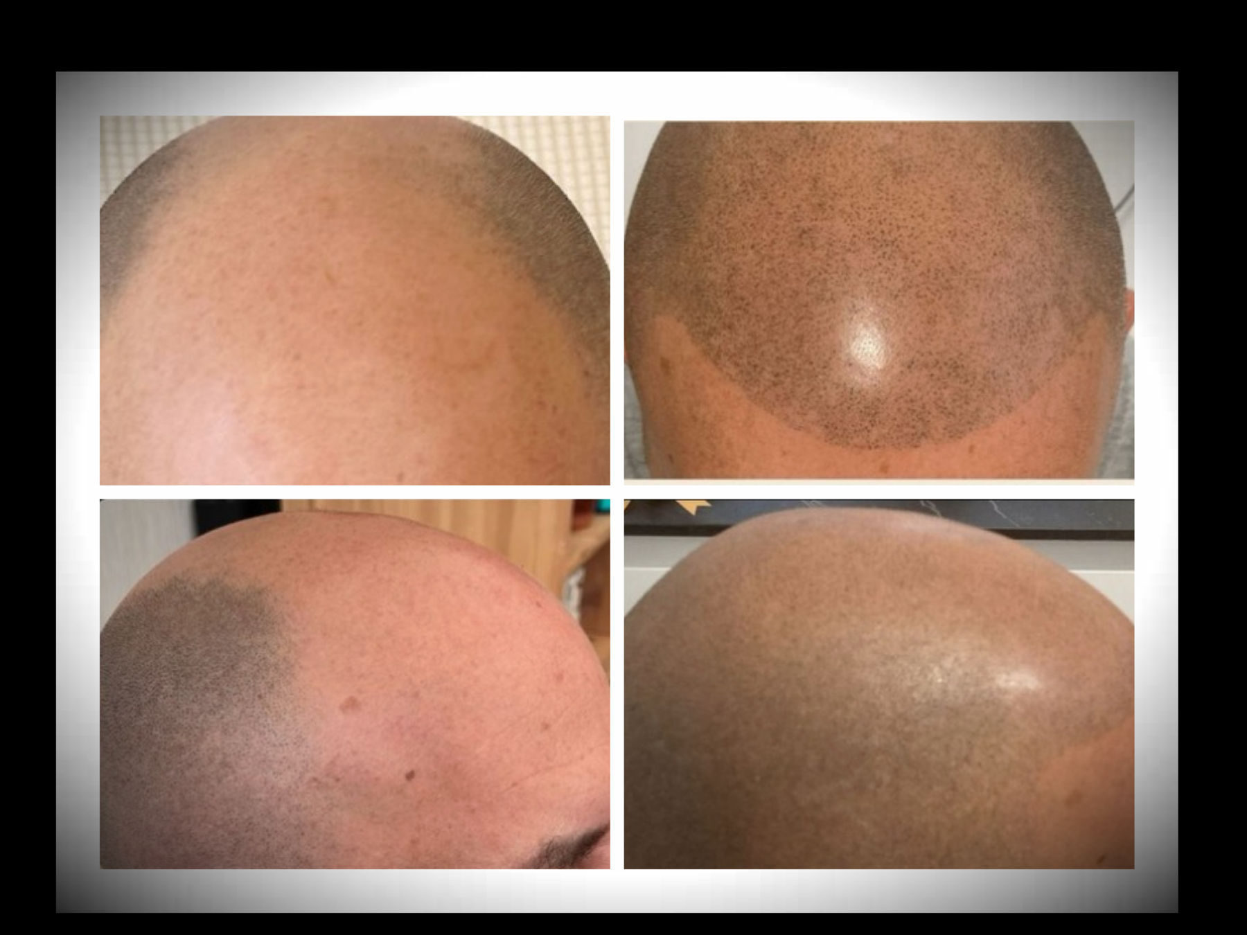 Micropigmentation west london smp